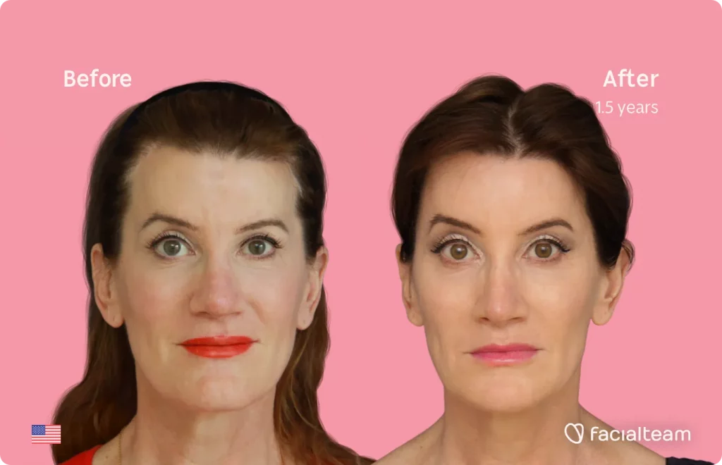 Side image of FFS patient Charlotte K showing the results before and after facial feminization surgery with Facialteam consisting of forehead, rhinoplasty, jaw and chin, lip feminization surgery.