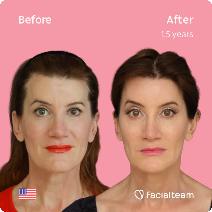 Square frontal image of FFS patient Danielle showing the results before and after facial feminization surgery with Facialteam consisting of forehead, jaw and chin, lip feminization surgery.