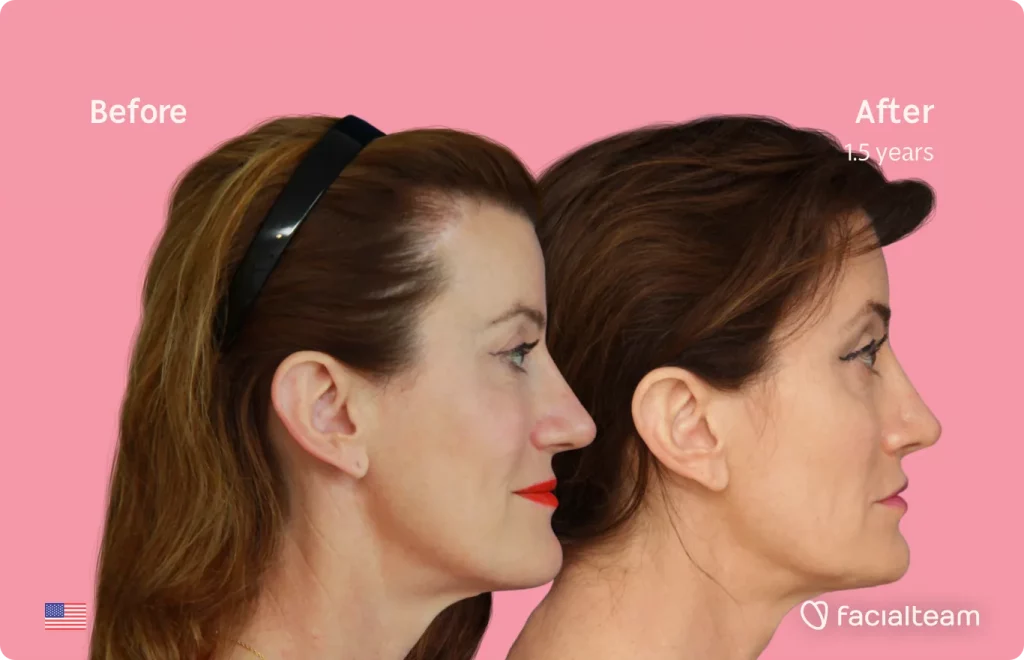 Side image of FFS patient Danielle showing the results before and after facial feminization surgery with Facialteam consisting of forehead, jaw and chin, lip feminization surgery.