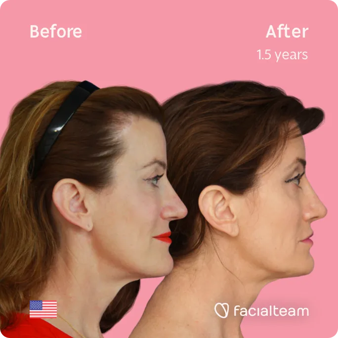 Square Side image of FFS patient Danielle showing the results before and after facial feminization surgery with Facialteam consisting of forehead, jaw and chin, lip feminization surgery.