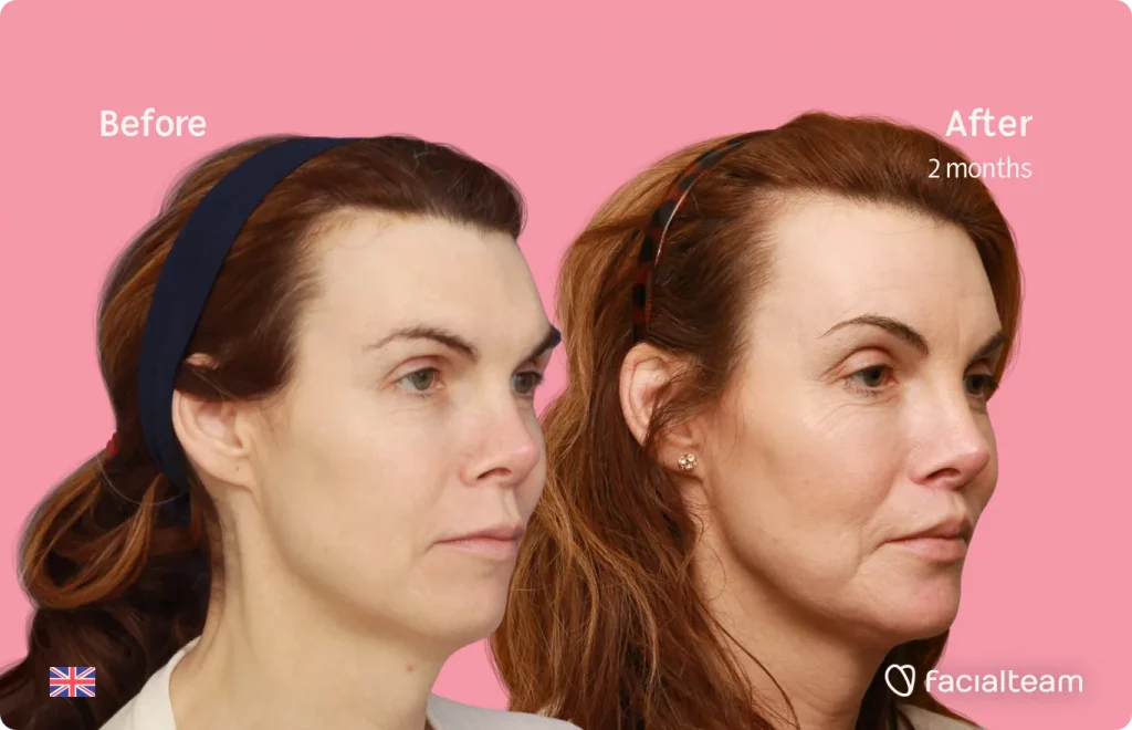 45 degree image of FFS patient Jacqueline G showing the results before and after facial feminization surgery consisting of forehead, jaw and chin, lip feminization surgery.