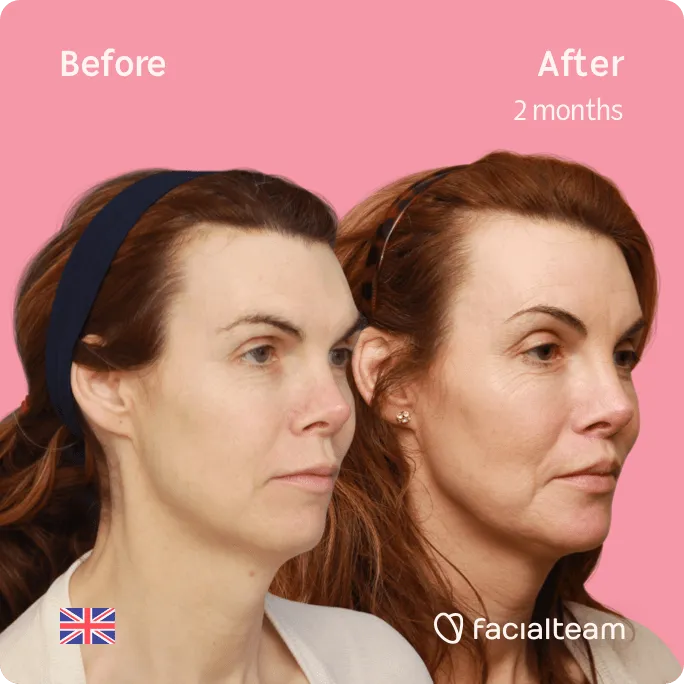 Square 45 degree image of FFS patient Jacqueline G showing the results before and after facial feminization surgery consisting of forehead, jaw and chin, lip feminization surgery.