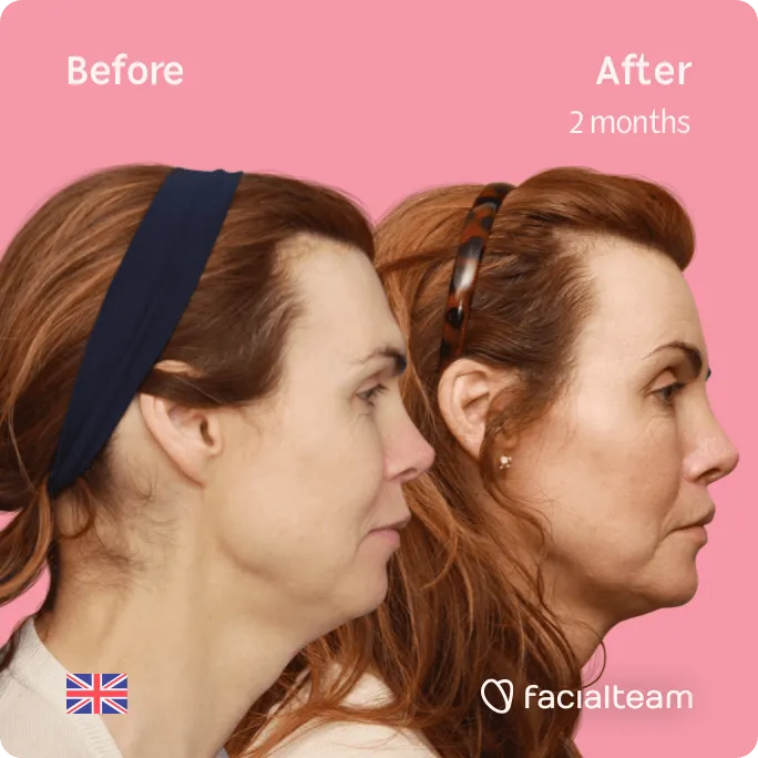 Square Side image of FFS patient Jacqueline G showing the results before and after facial feminization surgery with Facialteam consisting of forehead, jaw and chin, lip feminization surgery.