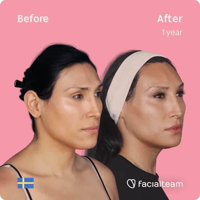 Square 45 degree image of FFS patient Renée showing the results before and after facial feminization surgery consisting of forehead, jaw and chin, lip feminization surgery.