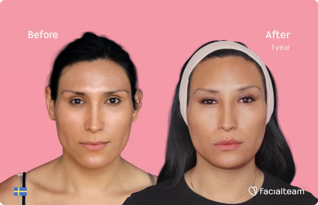 Frontal image of FFS patient Renée showing the results before and after facial feminization surgery with Facialteam consisting of forehead, jaw and chin, lip feminization surgery.