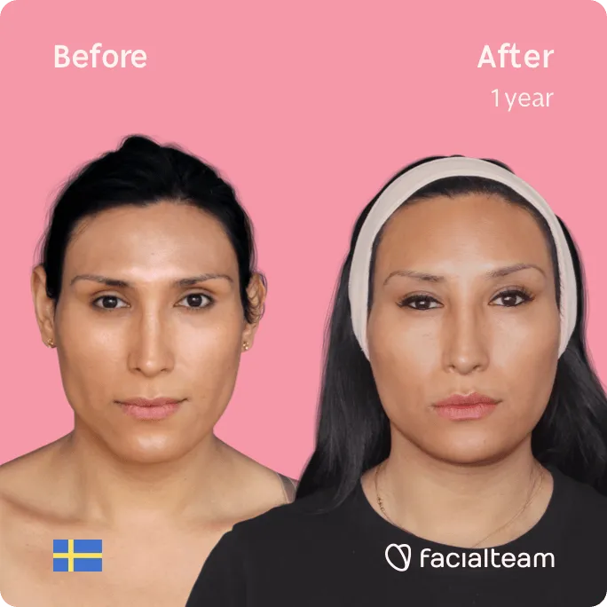 Square frontal image of FFS patient Renée showing the results before and after facial feminization surgery with Facialteam consisting of forehead, jaw and chin, lip feminization surgery.