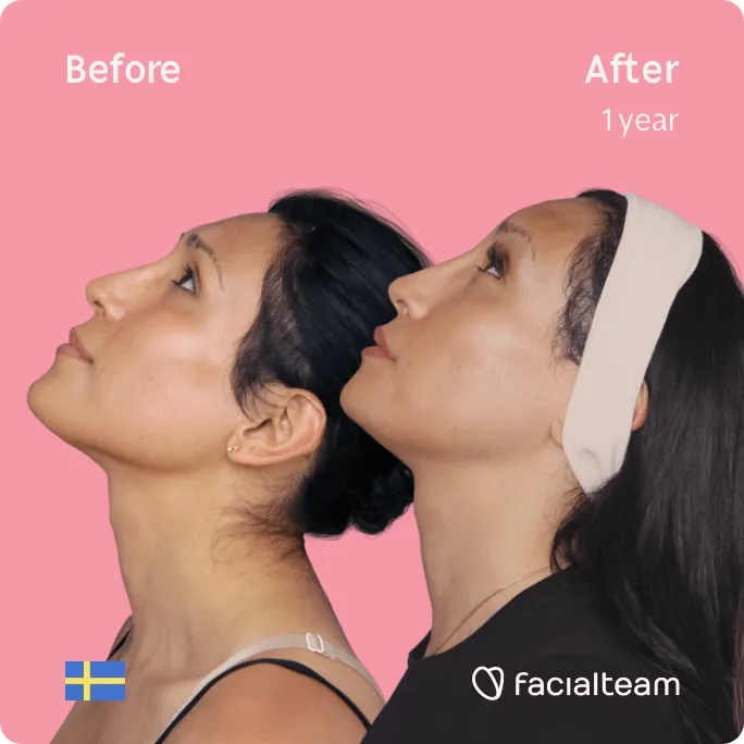 Square Side image of FFS patient Renée showing the results before and after facial feminization surgery with Facialteam consisting of forehead, jaw and chin, lip feminization surgery.