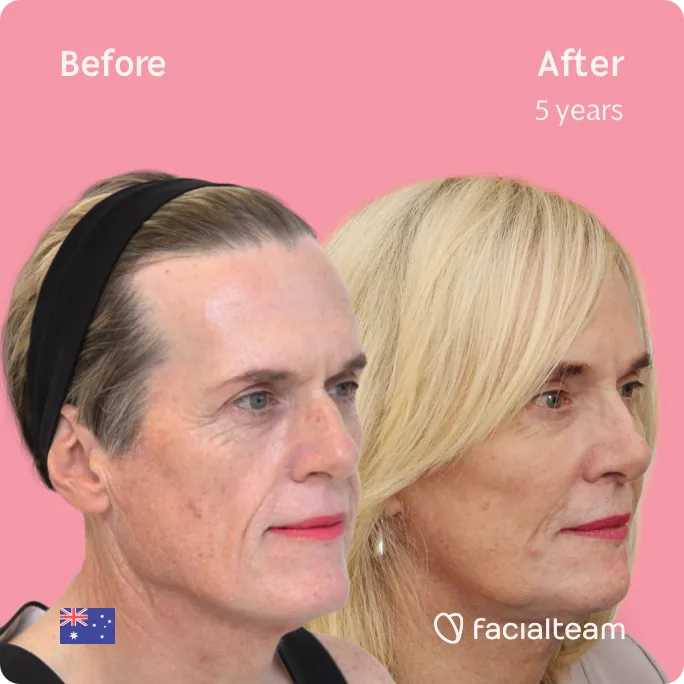 Square 45 degree image of FFS patient Alice showing the results before and after facial feminization surgery consisting of forehead, jaw and chin, rhinoplasty feminization surgery.
