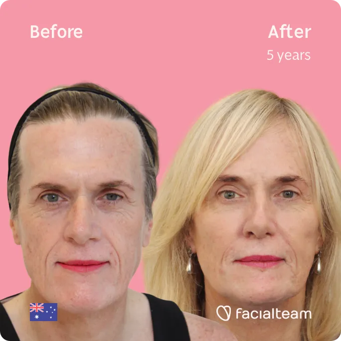 Square frontal image of FFS patient Alice showing the results before and after facial feminization surgery with Facialteam consisting of forehead, jaw and chin, rhinoplasty feminization surgery.