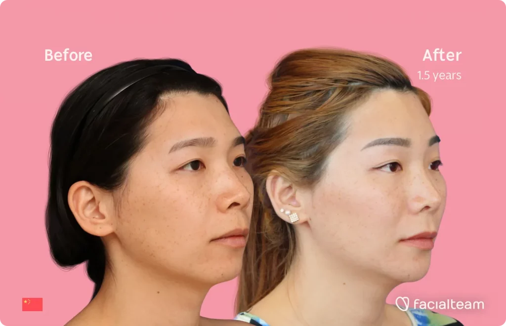 45 degree image of FFS patient Harriet showing the results before and after facial feminization surgery consisting of forehead, jaw and chin, rhinoplasty feminization surgery.