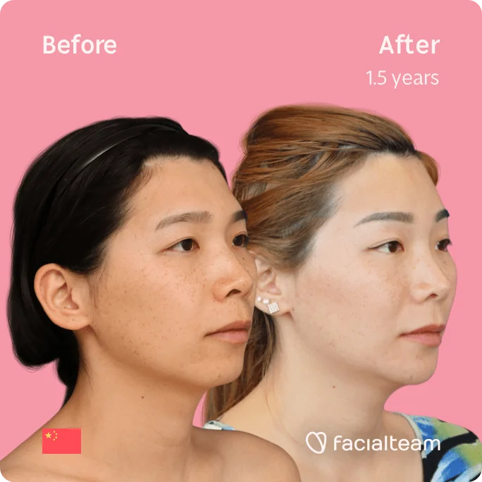 Square 45 degree image of FFS patient Harriet showing the results before and after facial feminization surgery consisting of forehead, jaw and chin, rhinoplasty feminization surgery.