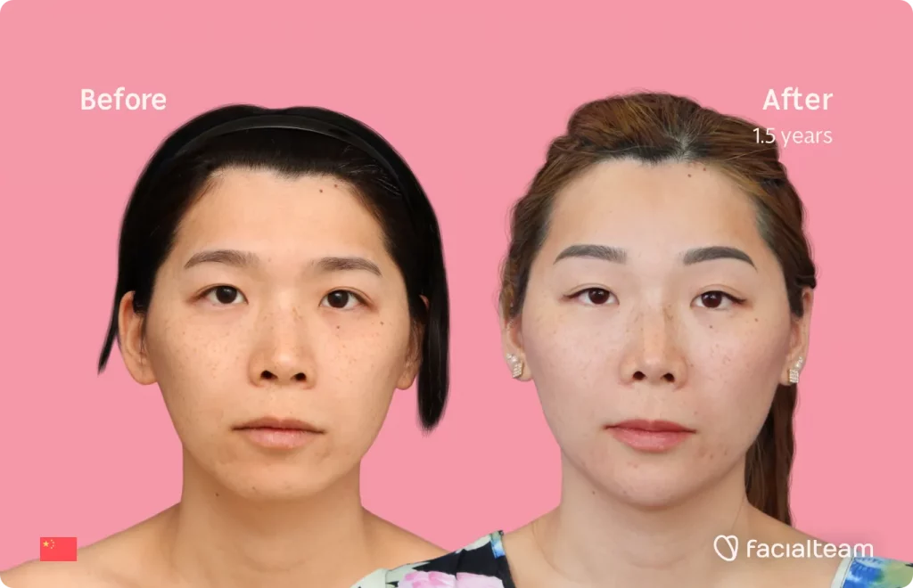 Frontal image of FFS patient Harriet showing the results before and after facial feminization surgery with Facialteam consisting of forehead, jaw and chin, rhinoplasty feminization surgery.
