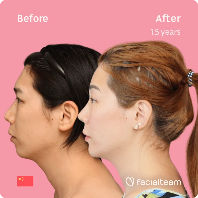 Square left side image of FFS patient Harriet showing the results before and after facial feminization surgery with Facialteam consisting of forehead, jaw and chin, rhinoplasty feminization surgery.