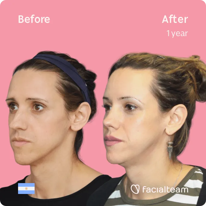 Square 45 degree image of FFS patient Luana showing the results before and after facial feminization surgery consisting of forehead, jaw and chin, rhinoplasty feminization surgery.
