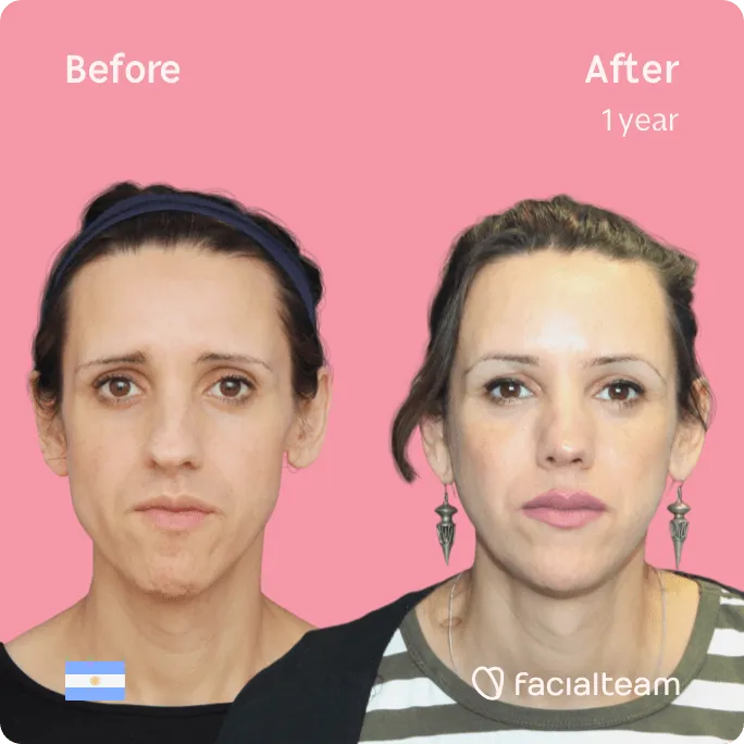 Square frontal image of FFS patient Luana showing the results before and after facial feminization surgery with Facialteam consisting of forehead, jaw and chin, rhinoplasty feminization surgery.