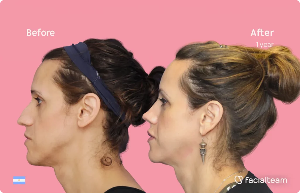 Side image of FFS patient Luana showing the results before and after facial feminization surgery with Facialteam consisting of forehead, jaw and chin, rhinoplasty feminization surgery.