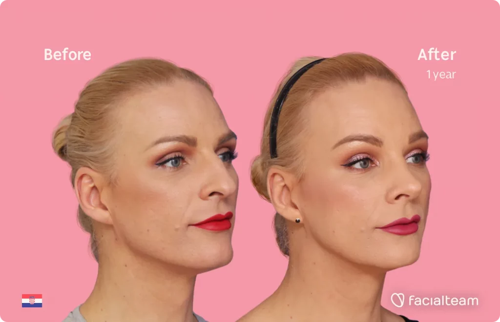 45 degree image of FFS patient Nina showing the results before and after facial feminization surgery consisting of forehead, jaw and chin, rhinoplasty feminization surgery.