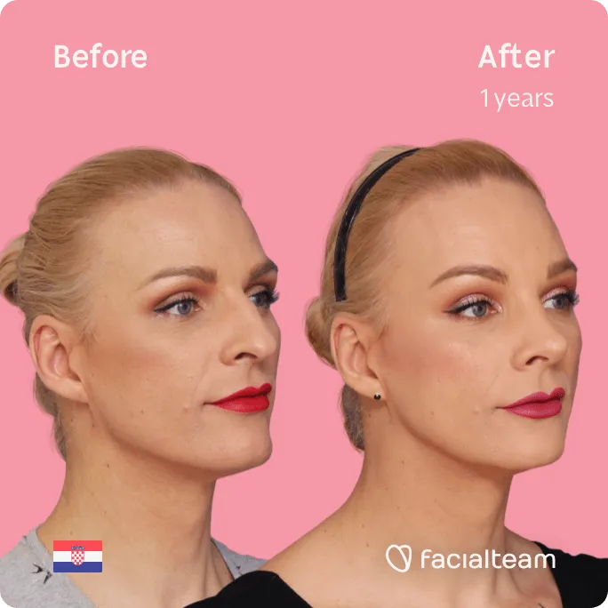 Square 45 degree image of FFS patient Nina showing the results before and after facial feminization surgery consisting of forehead, jaw and chin, rhinoplasty feminization surgery.
