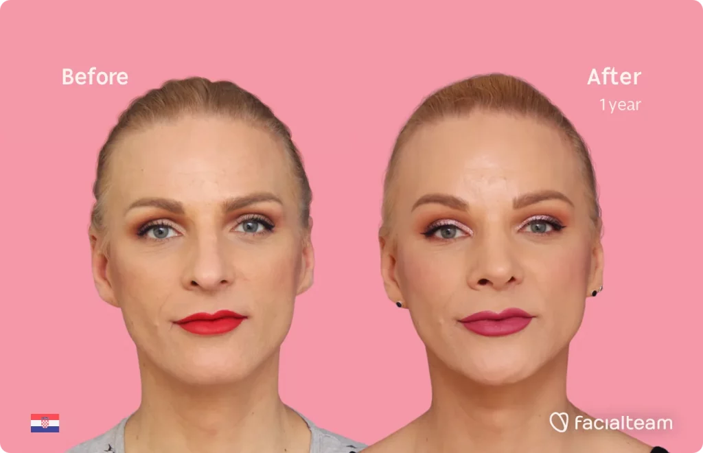 Frontal image of FFS patient Nina showing the results before and after facial feminization surgery with Facialteam consisting of forehead, jaw and chin, rhinoplasty feminization surgery.