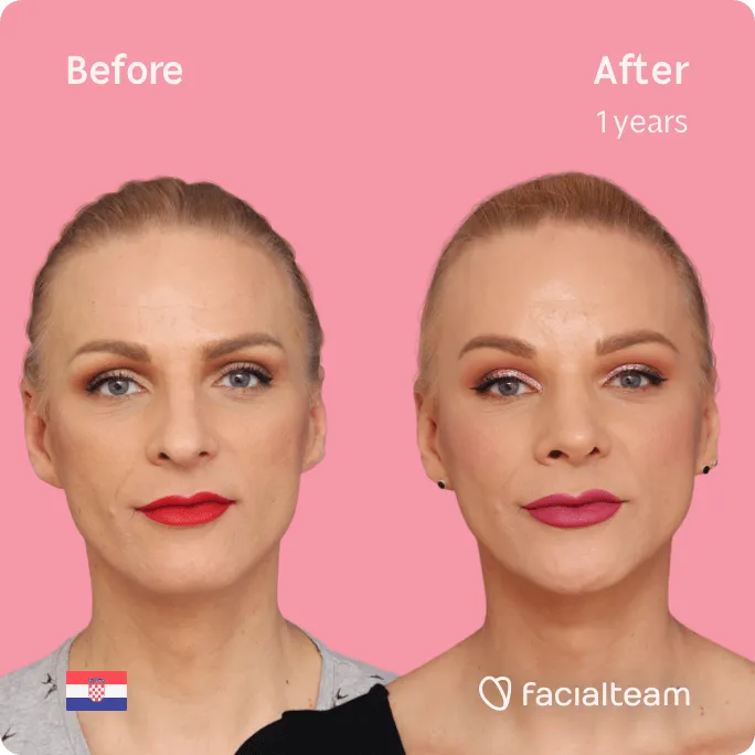 Square frontal image of FFS patient Nina showing the results before and after facial feminization surgery with Facialteam consisting of forehead, jaw and chin, rhinoplasty feminization surgery.