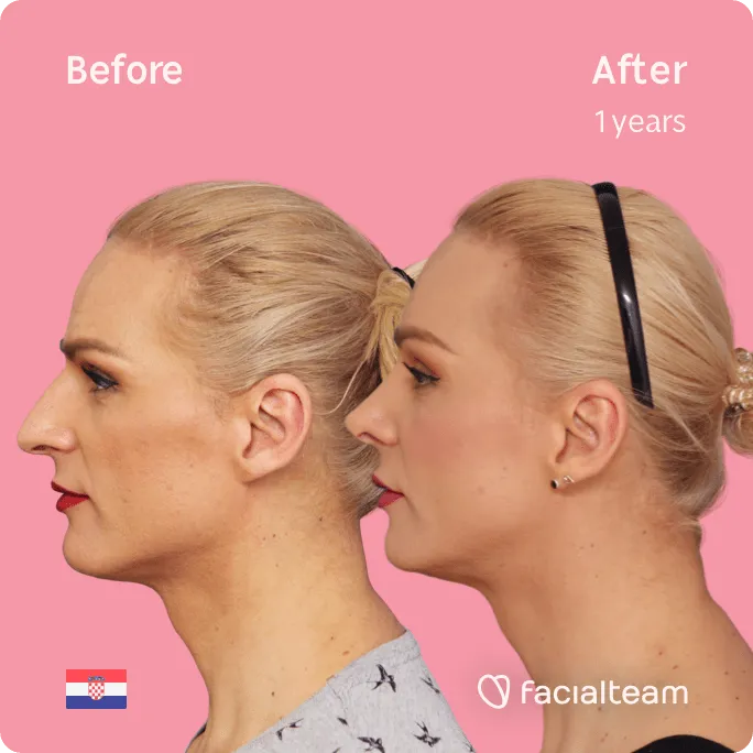 Square Side image of FFS patient Nina showing the results before and after facial feminization surgery with Facialteam consisting of forehead, jaw and chin, rhinoplasty feminization surgery.