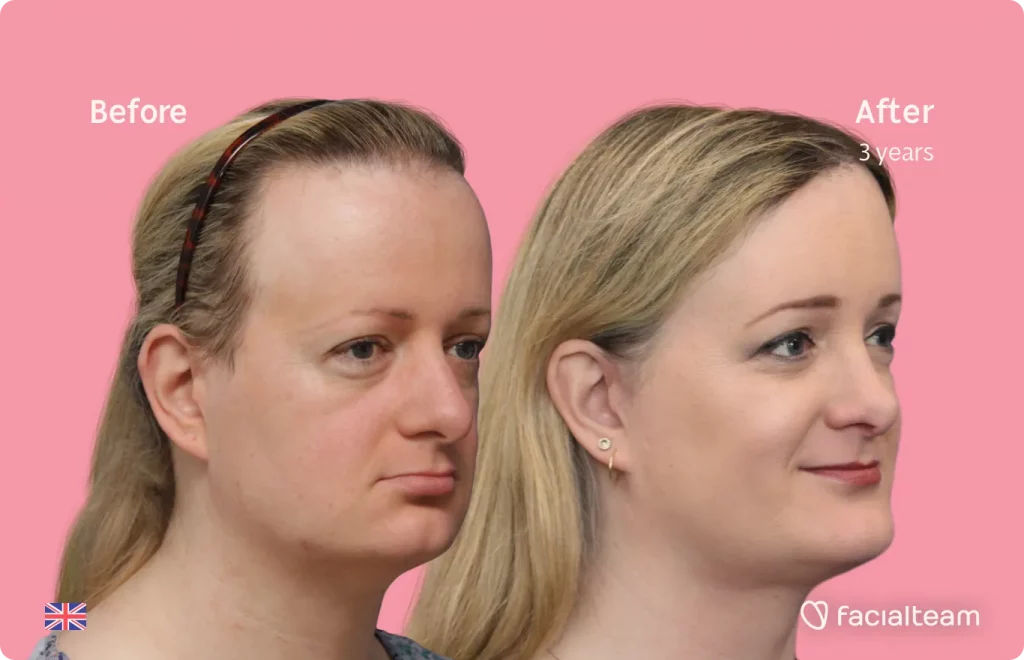 45 degree image of FFS patient Sarah O showing the results before and after facial feminization surgery consisting of forehead, jaw and chin, rhinoplasty feminization surgery.