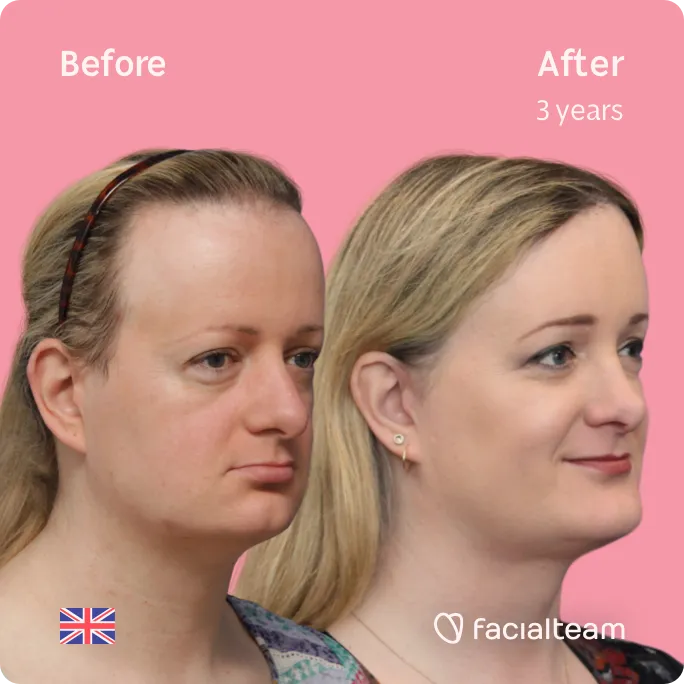 Square 45 degree image of FFS patient Sarah O showing the results before and after facial feminization surgery consisting of forehead, jaw and chin, rhinoplasty feminization surgery.