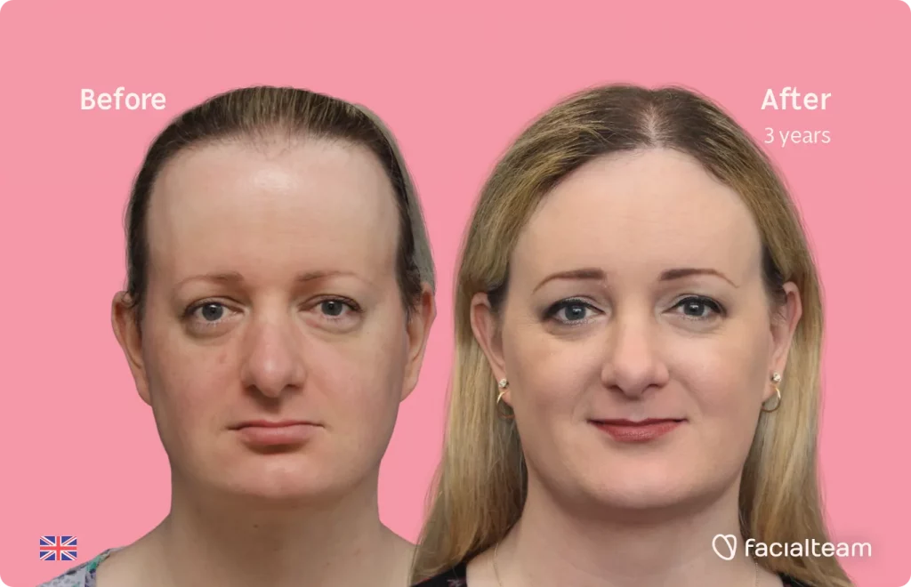 Frontal image of FFS patient Sarah O showing the results before and after facial feminization surgery with Facialteam consisting of forehead, jaw and chin, rhinoplasty feminization surgery.