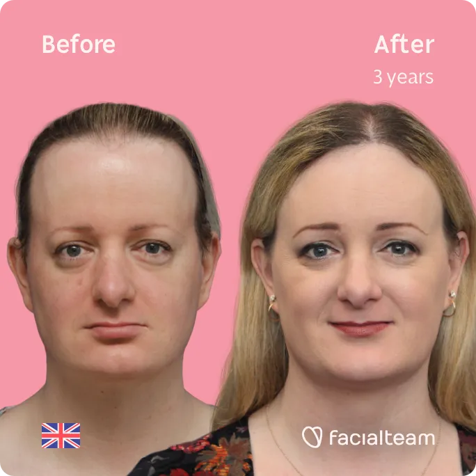 Square frontal image of FFS patient Sarah O showing the results before and after facial feminization surgery with Facialteam consisting of forehead, jaw and chin, rhinoplasty feminization surgery.