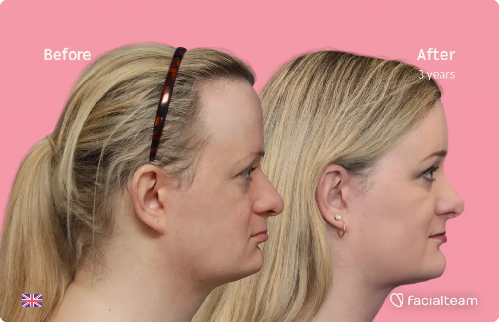 Side image of FFS patient Sarah O showing the results before and after facial feminization surgery with Facialteam consisting of forehead, jaw and chin, rhinoplasty feminization surgery.