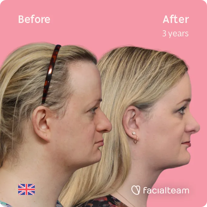 Square Side image of FFS patient Sarah O showing the results before and after facial feminization surgery with Facialteam consisting of forehead, jaw and chin, rhinoplasty feminization surgery.