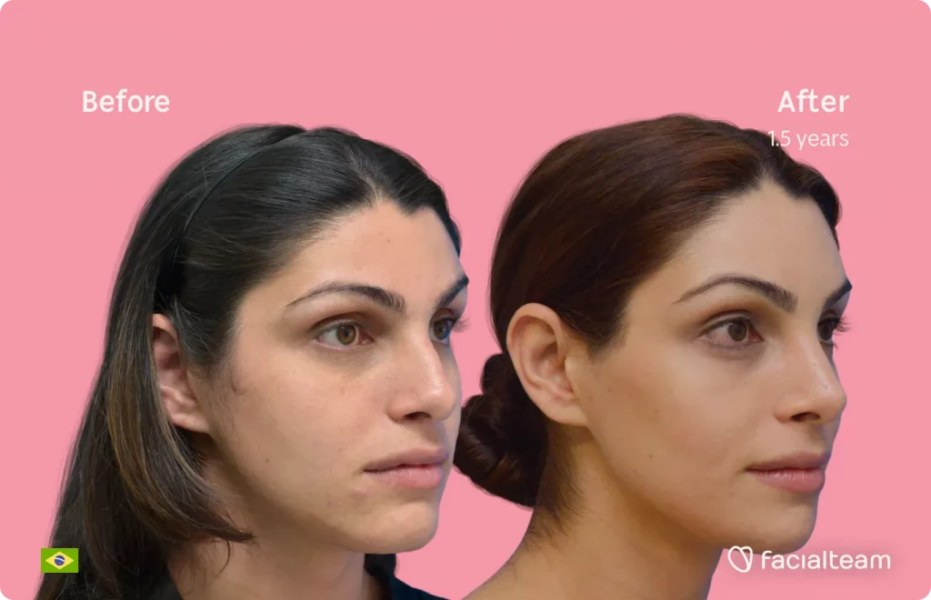 45 degree image of FFS patient Rafaela showing the results before and after facial feminization surgery consisting of forehead, jaw and chin, rhinoplasty, tracheal shave feminization surgery.