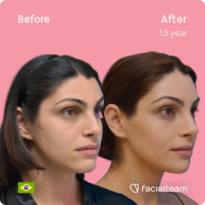 Square 45 degree image of FFS patient Rafaela showing the results before and after facial feminization surgery consisting of forehead, jaw and chin, rhinoplasty, tracheal shave feminization surgery.