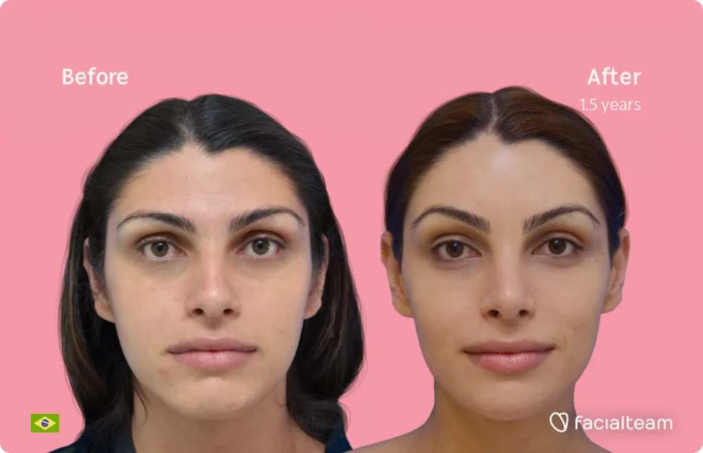 Frontal image of FFS patient Rafaela showing the results before and after facial feminization surgery with Facialteam consisting of forehead, jaw and chin, rhinoplasty, tracheal shave feminization surgery.