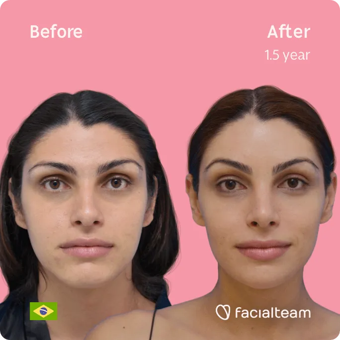 Square frontal image of FFS patient Rafaela showing the results before and after facial feminization surgery with Facialteam consisting of forehead, jaw and chin, rhinoplasty, tracheal shave feminization surgery.