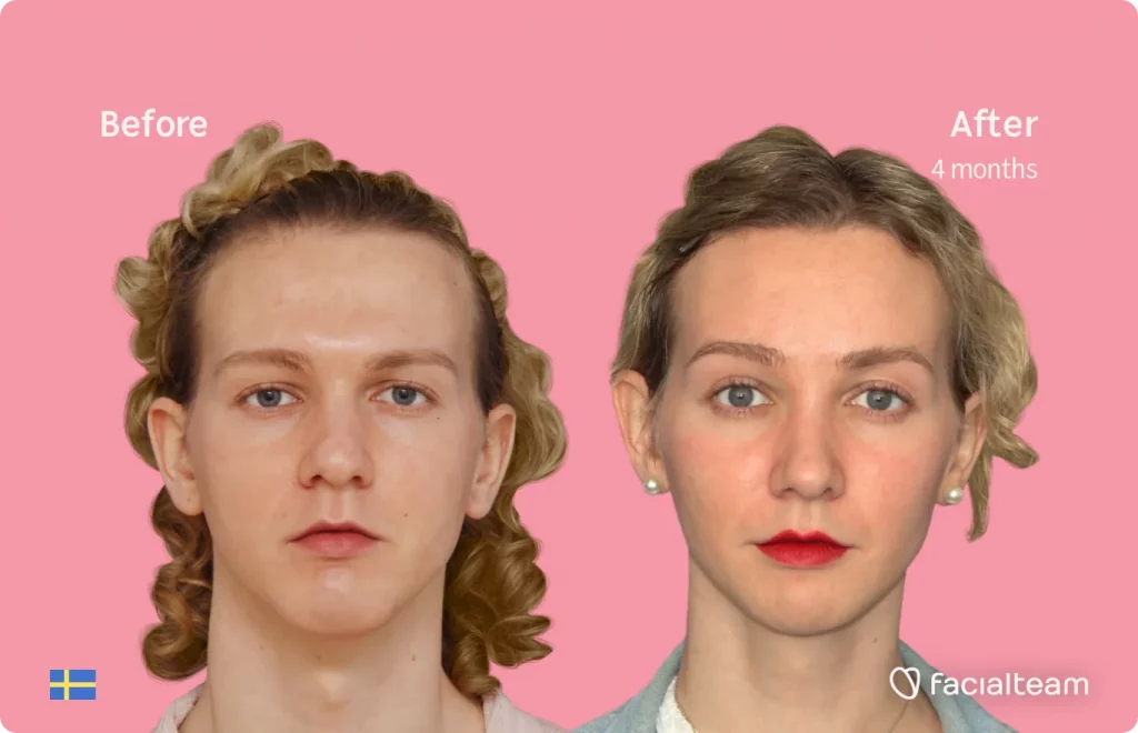 Frontal image of FFS patient Saga showing the results before and after facial feminization surgery with Facialteam consisting of forehead, jaw and chin, rhinoplasty, tracheal shave feminization surgery.