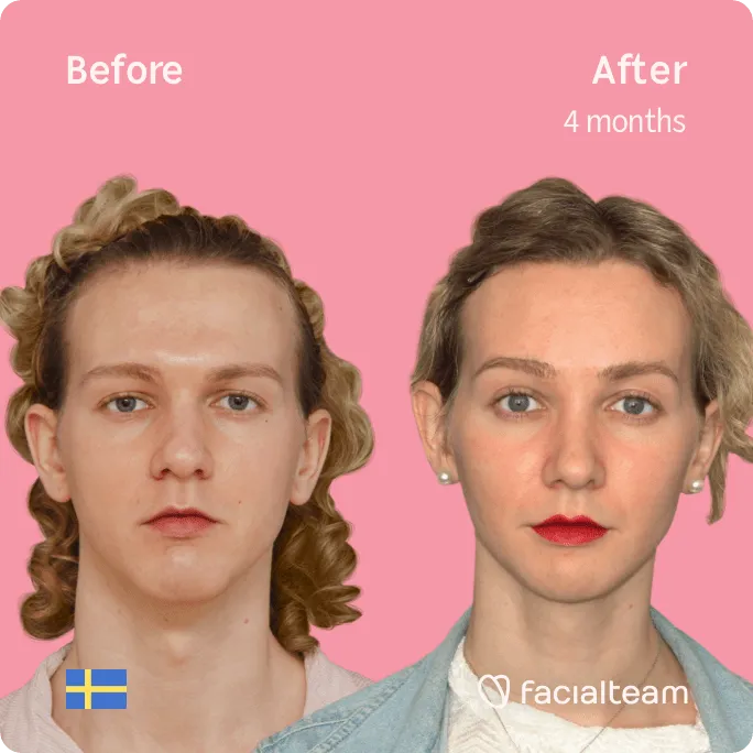 Square frontal image of FFS patient Saga showing the results before and after facial feminization surgery with Facialteam consisting of forehead, jaw and chin, rhinoplasty, tracheal shave feminization surgery.