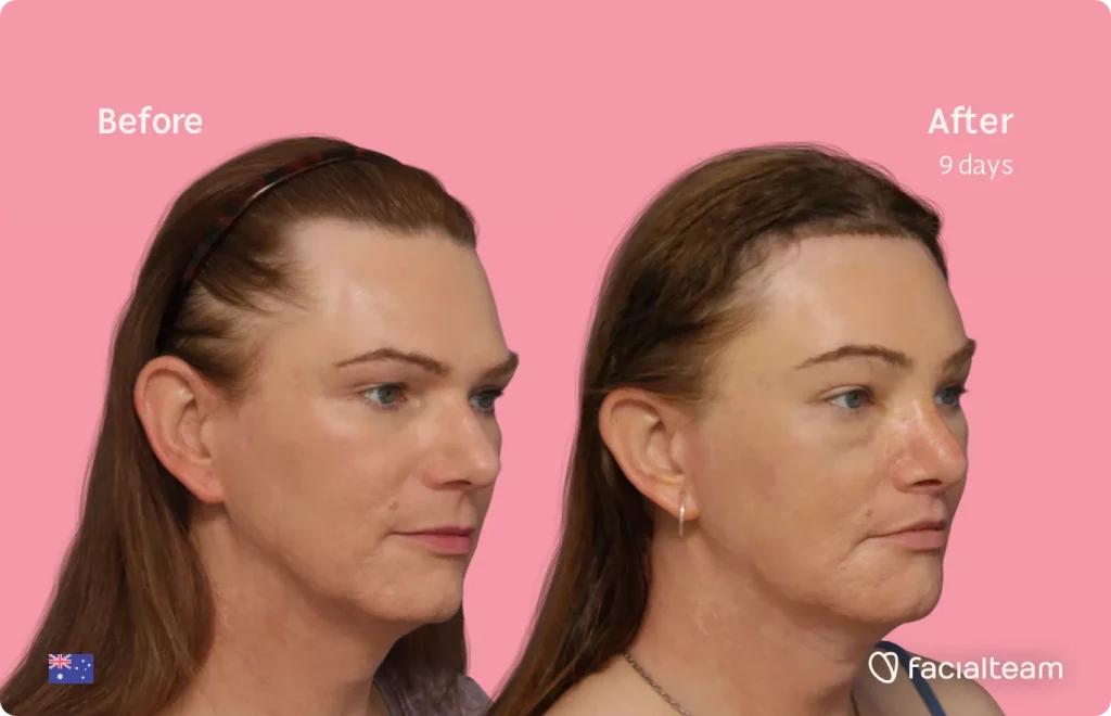 45 degree image of FFS patient Kate showing the results before and after facial feminization surgery consisting of forehead, jaw and chin, rhinoplasty, tracheal shave, lip feminization surgery.