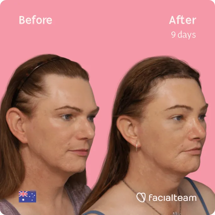Square 45 degree image of FFS patient Kate showing the results before and after facial feminization surgery consisting of forehead, jaw and chin, rhinoplasty, tracheal shave, lip feminization surgery.