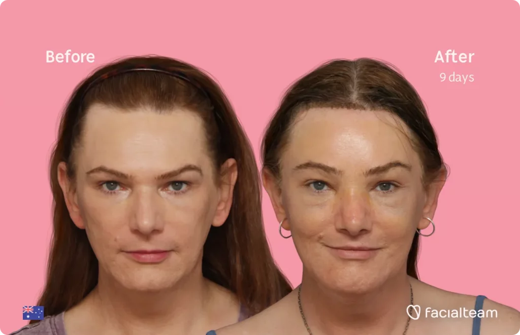 Frontal image of FFS patient Kate showing the results before and after facial feminization surgery with Facialteam consisting of forehead, jaw and chin, rhinoplasty, tracheal shave, lip feminization surgery.