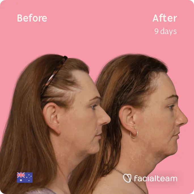 Square Side image of FFS patient Kate showing the results before and after facial feminization surgery with Facialteam consisting of forehead, jaw and chin, rhinoplasty, tracheal shave, lip feminization surgery.