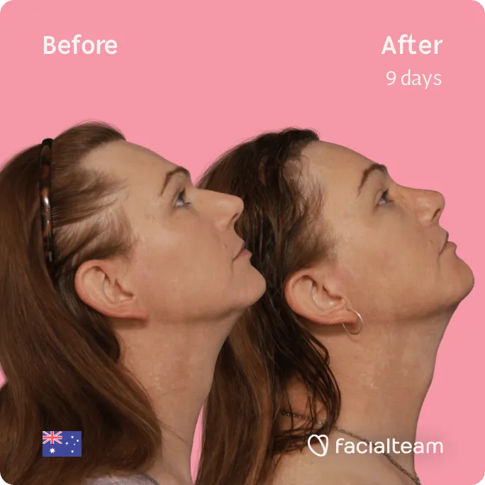 Square Side up image of FFS patient Kate showing the results before and after facial feminization surgery with Facialteam consisting of forehead, jaw and chin, rhinoplasty, tracheal shave, lip feminization surgery.