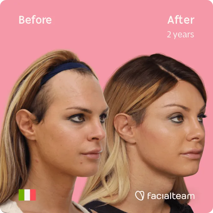 Square 45 degree image of FFS patient Noemi showing the results before and after facial feminization surgery consisting of forehead, jaw and chin, tracheal shave feminization surgery.
