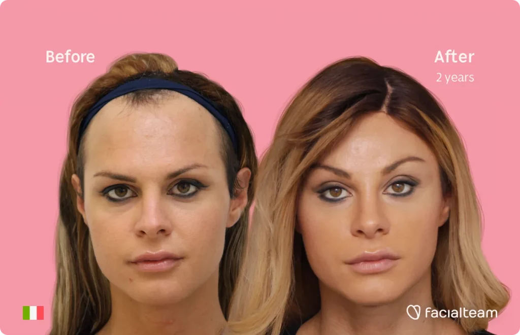 Frontal image of FFS patient Noemi showing the results before and after facial feminization surgery with Facialteam consisting of forehead, jaw and chin, tracheal shave feminization surgery.