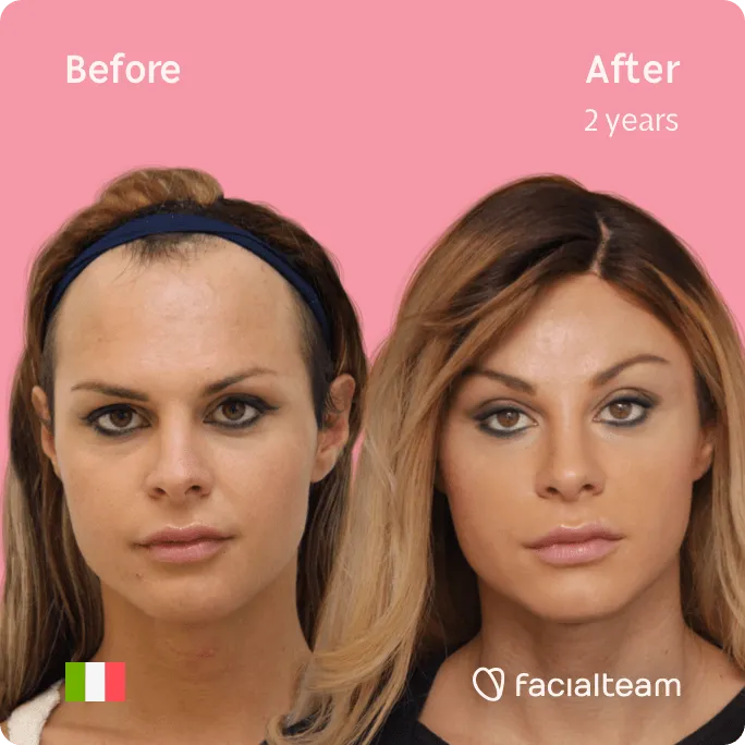 Square frontal image of FFS patient Noemi showing the results before and after facial feminization surgery with Facialteam consisting of forehead, jaw and chin, tracheal shave feminization surgery.