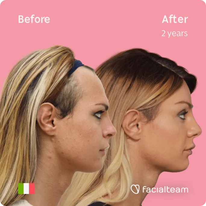 Square Side image of FFS patient Noemi showing the results before and after facial feminization surgery with Facialteam consisting of forehead, jaw and chin, tracheal shave feminization surgery.