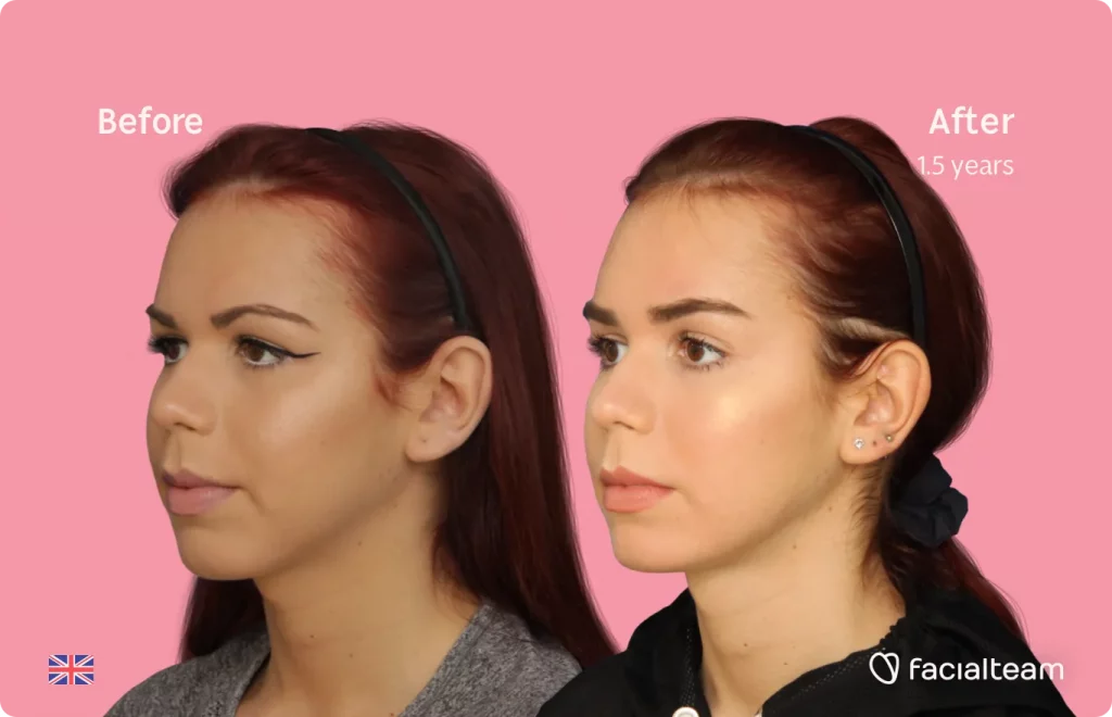 45 degree image of FFS patient Wren showing the results before and after facial feminization surgery consisting of forehead, jaw and chin, tracheal shave feminization surgery.