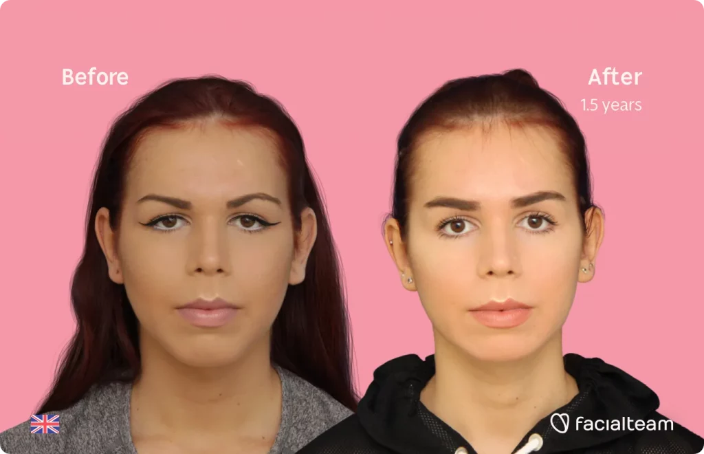Frontal image of FFS patient Wren showing the results before and after facial feminization surgery with Facialteam consisting of forehead, jaw and chin, tracheal shave feminization surgery.