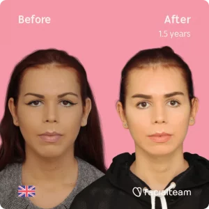 FFS patient Wren from the UK before and after FFS Surgery with Facialteam, she underwent Forehead surgery, jaw feminization and an Adam's apple reduction