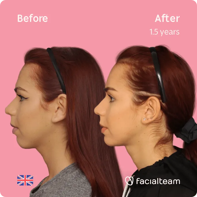 Square Side image of FFS patient Wren showing the results before and after facial feminization surgery with Facialteam consisting of forehead, jaw and chin, tracheal shave feminization surgery.